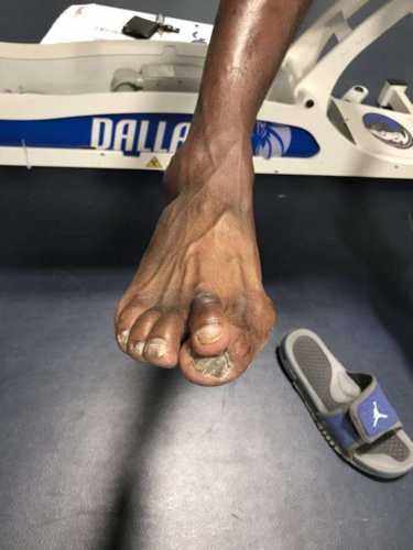 NBA球员与足底筋膜炎：挑战与康复之路-第1张图片-寰星运动网