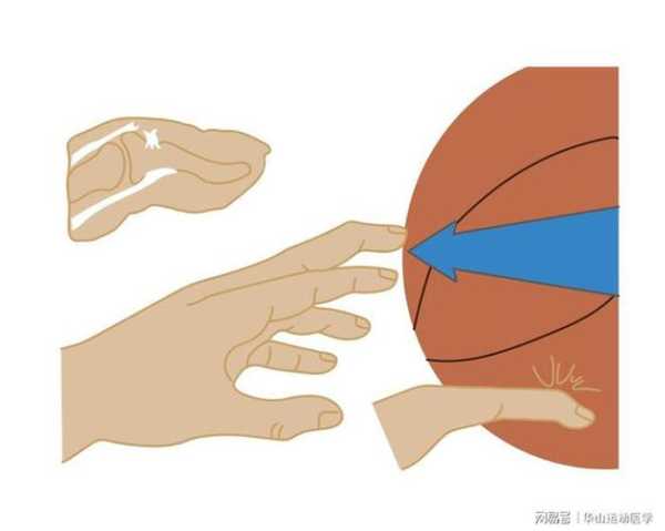 打篮球导致手指肿胀如萝卜-第2张图片-寰星运动网